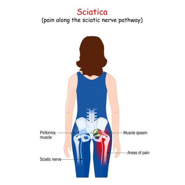 Piriformis Syndrome (entrapment of the sciatic nerve causing sciatica)